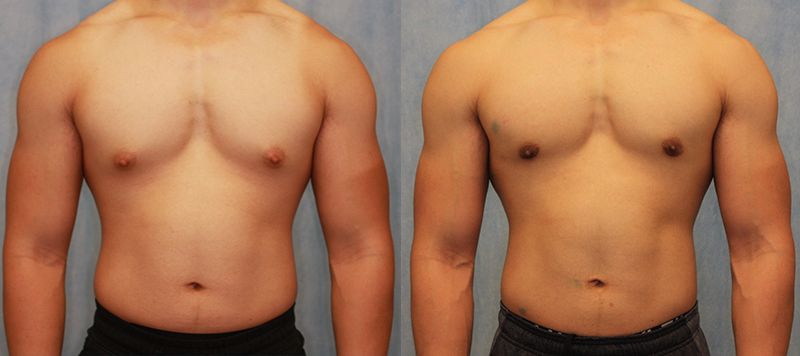 Male Gynecomastia Patient 7 Image 0