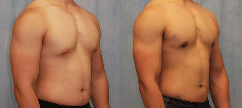 Male Gynecomastia Patient 7 Image 1