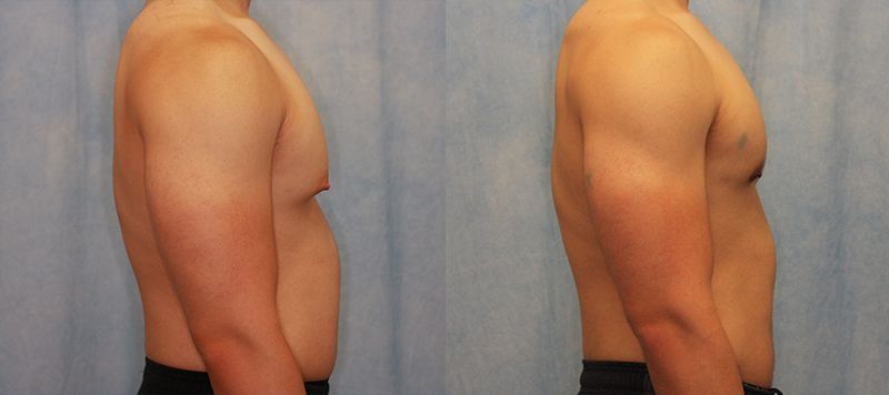 Male Gynecomastia Patient 7 Image 2