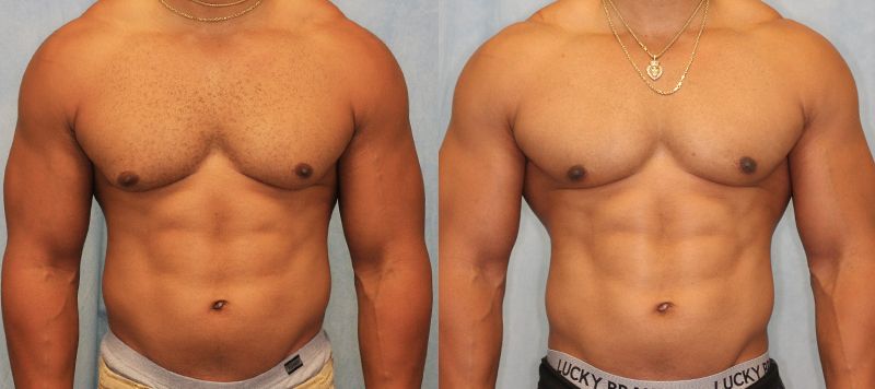 Male Gynecomastia Patient 8 Image 0