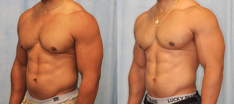 Male Gynecomastia Patient 8 Image 1