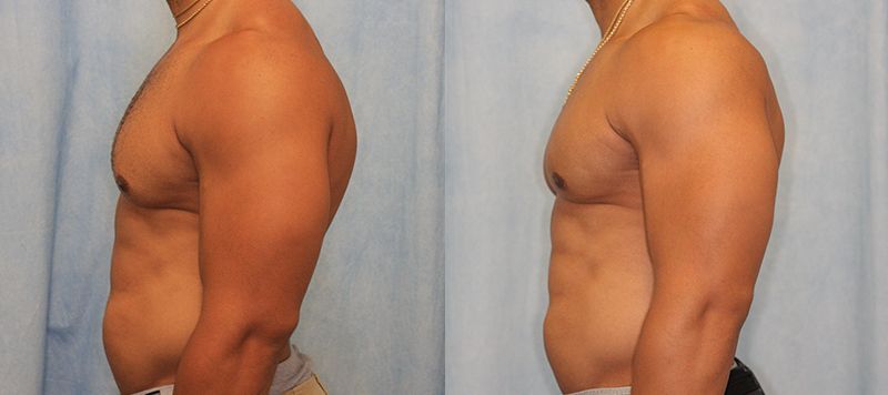 Male Gynecomastia Patient 8 Image 2