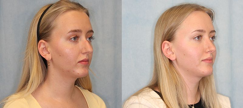 Rhinoplasty Patient 11 Image 1