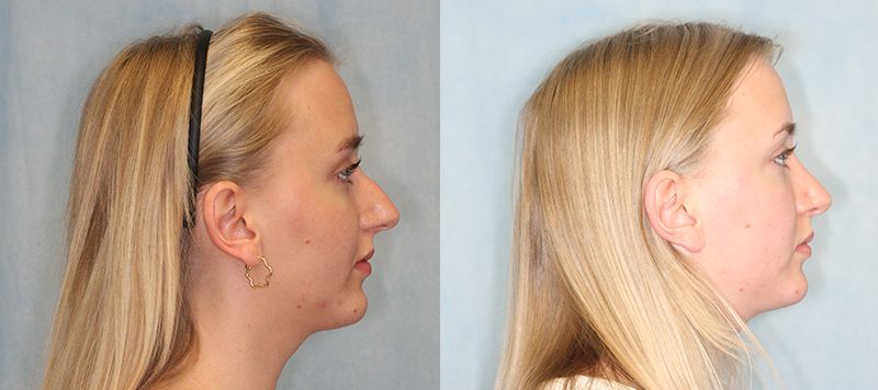 Rhinoplasty Patient 11 Image 2