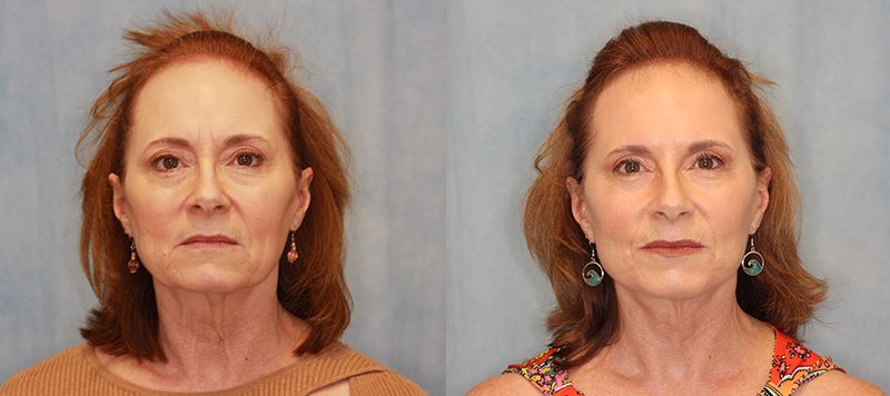 Facelift Patient 13 Image 0