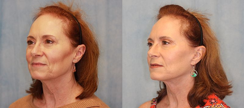 Facelift Patient 13 Image 1