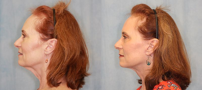 Facelift Patient 13 Image 2