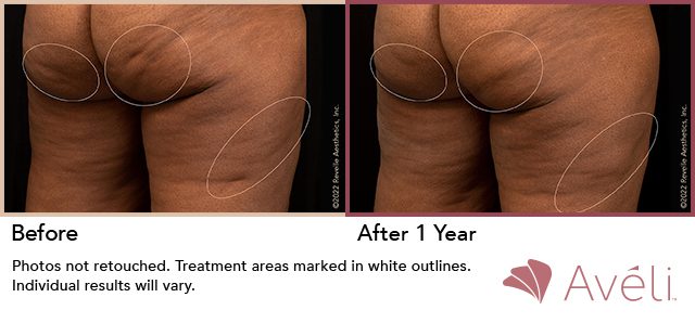Avéli™ Cellulite Reduction Before and After Photo 2