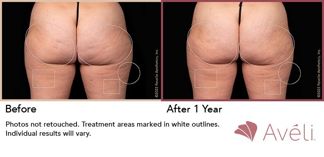 Avéli™ Cellulite Reduction Before and After Photo 6