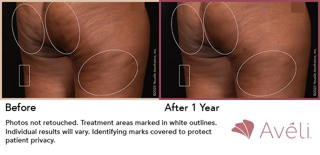 Avéli™ Cellulite Reduction Before and After Photo 15