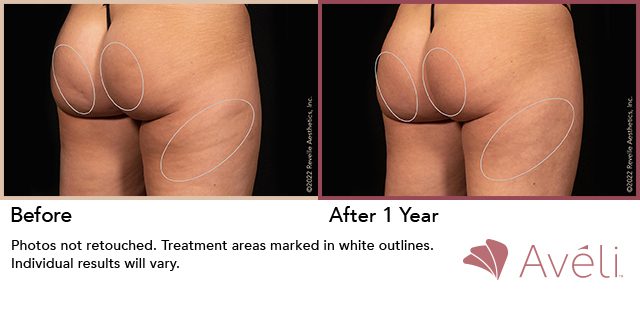 Avéli™ Cellulite Reduction Before and After Photo 0