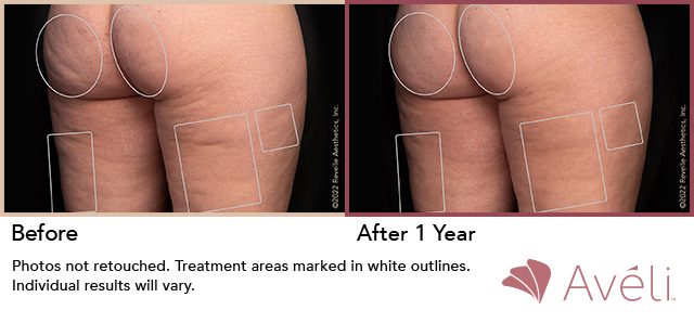 Avéli™ Cellulite Reduction Before and After Photo 3