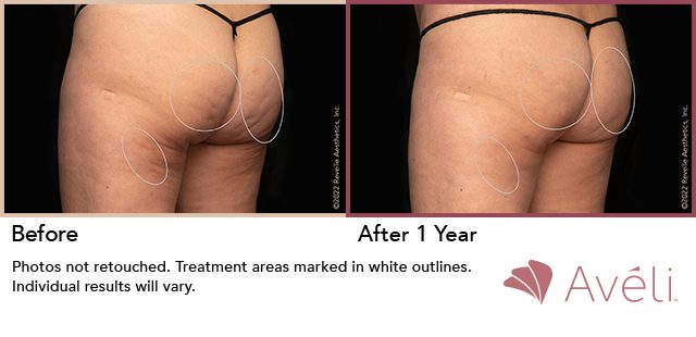 Avéli™ Cellulite Reduction Before and After Photo 10