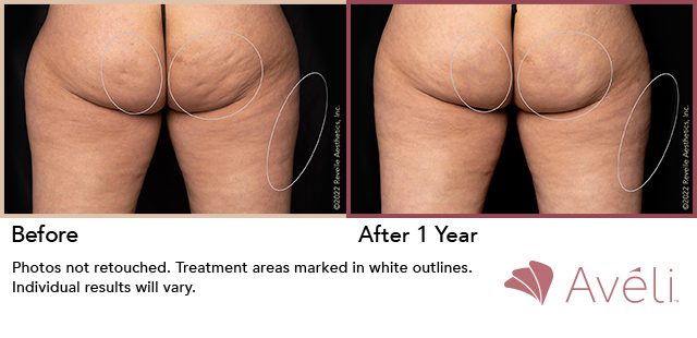 Avéli™ Cellulite Reduction Before and After Photo 1