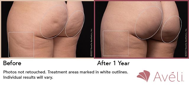 Avéli™ Cellulite Reduction Before and After Photo 7