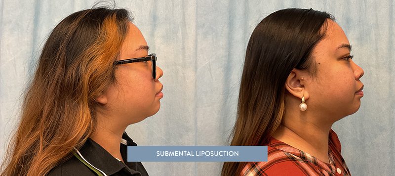 Liposuction Patient 8 Image 0