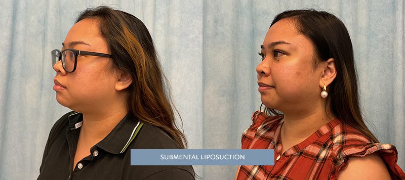 Liposuction Patient 8 Image 1
