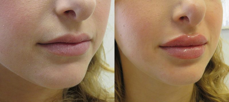 Lip Filler Patient 6 Image 0