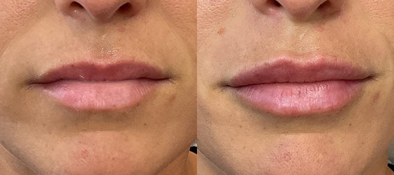 Lip Filler Patient 7 Image 0