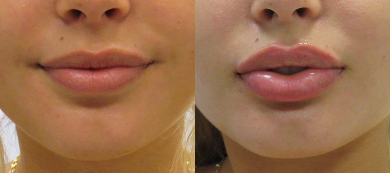 Lip Filler Patient 8 Image 0