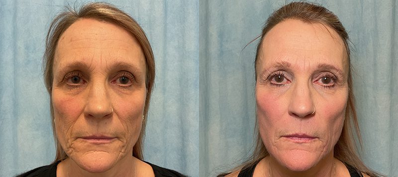 CO2 Laser Resurfacing Patient 1 Image 2
