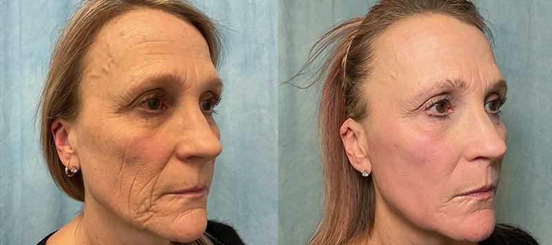 CO2 Laser Resurfacing Patient 1 Image 1