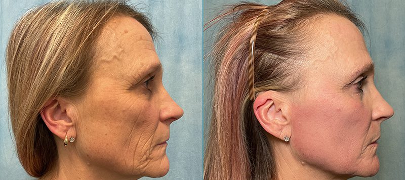 CO2 Laser Resurfacing Patient 1 Image 0