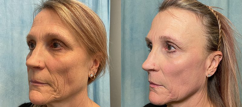 CO2 Laser Resurfacing Patient 1 Image 4