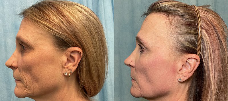 CO2 Laser Resurfacing Patient 1 Image 3