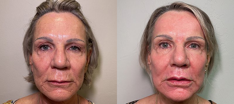CO2 Laser Resurfacing Patient 2 Image 1