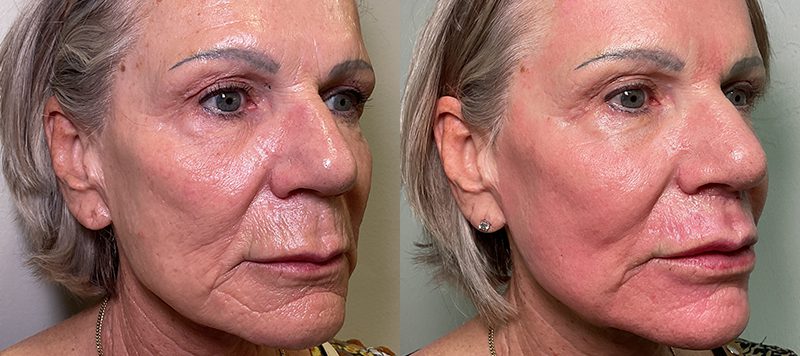 CO2 Laser Resurfacing Patient 2 Image 0