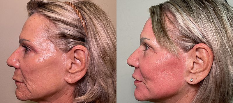 CO2 Laser Resurfacing Patient 2 Image 4