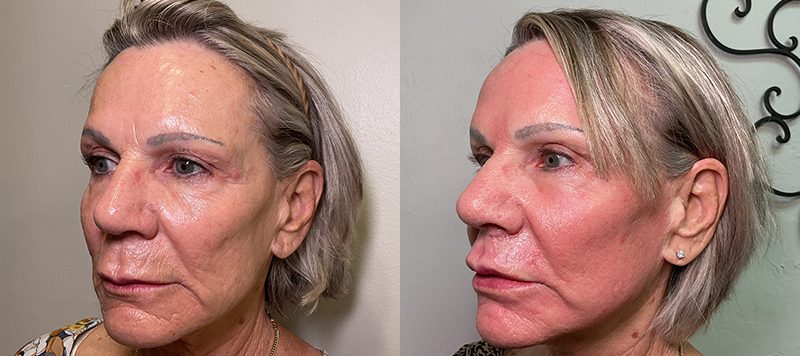 CO2 Laser Resurfacing Patient 2 Image 3