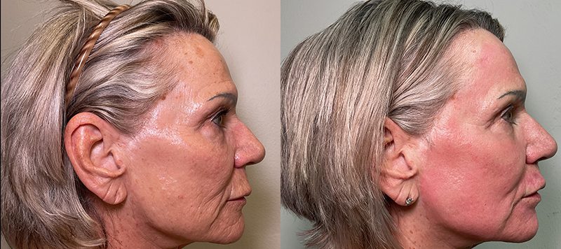 CO2 Laser Resurfacing Patient 2 Image 2