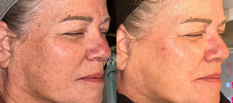Aggressive Skincare Protocol Patient 1 Image 0