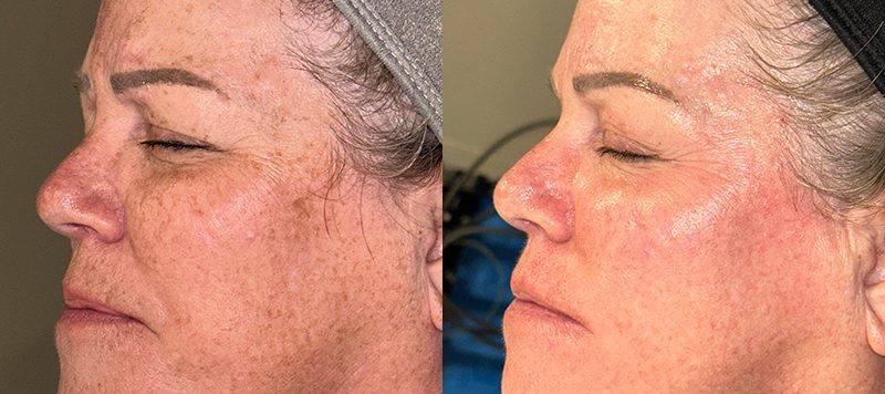 Aggressive Skincare Protocol Patient 1 Image 1
