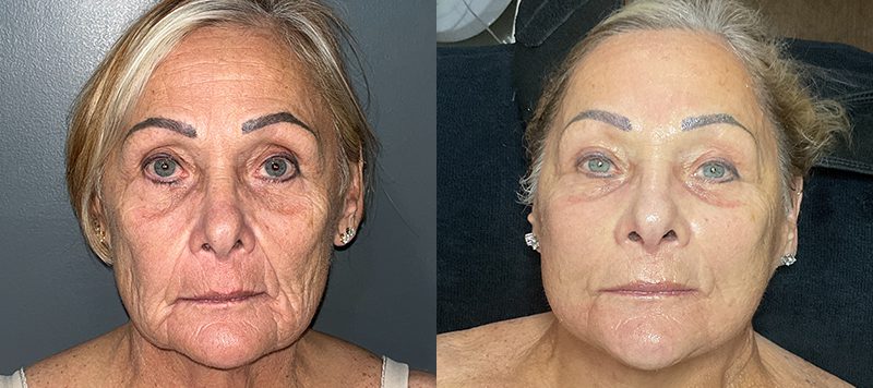 Aggressive Skincare Protocol Patient 2 Image 0