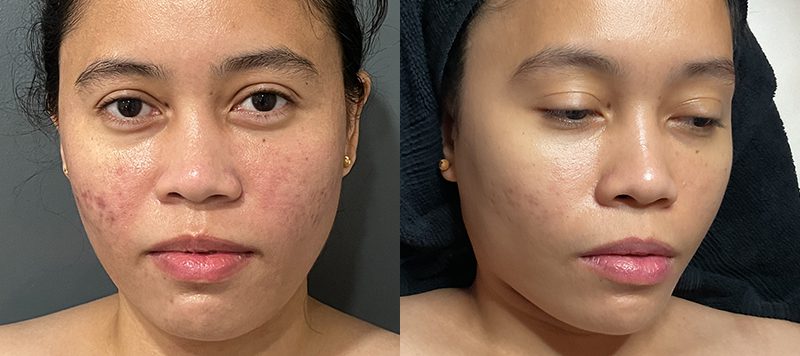 Skin Care Patient 2 Image 1