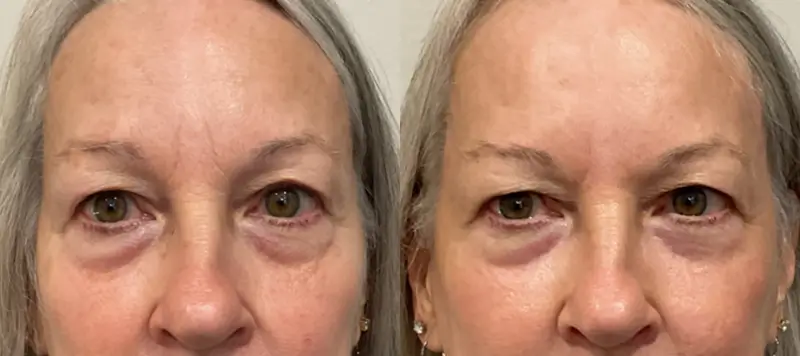 CO2 Laser Resurfacing Patient 4 Image 0