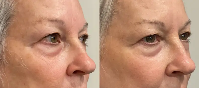CO2 Laser Resurfacing Patient 4 Image 1
