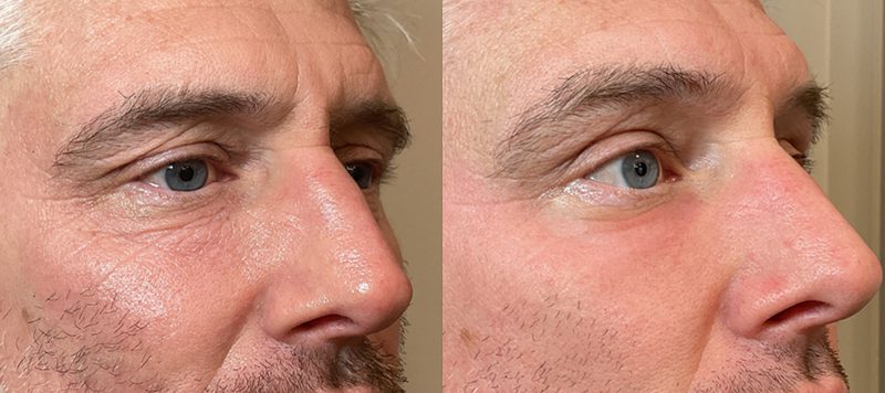 CO2 Laser Resurfacing Patient 3 Image 1