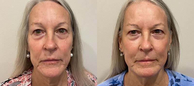 CO2 Laser Resurfacing Patient 4 Image 0
