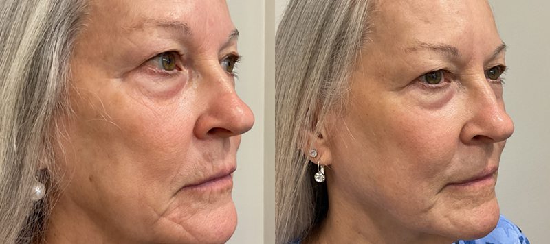 CO2 Laser Resurfacing Patient 4 Image 1