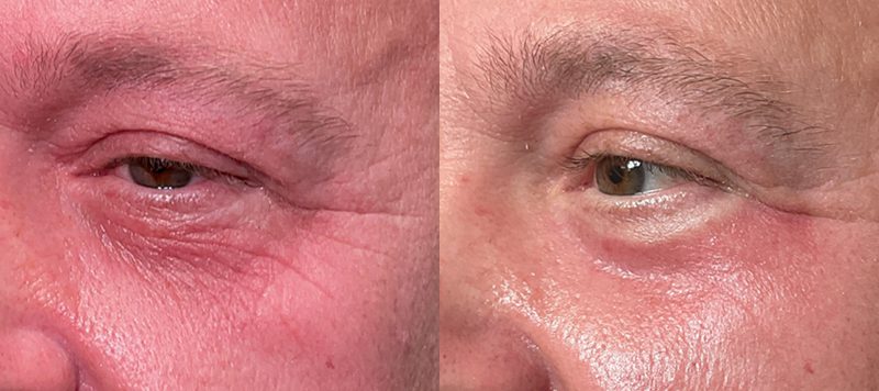 CO2 Laser Resurfacing Patient 5 Image 1