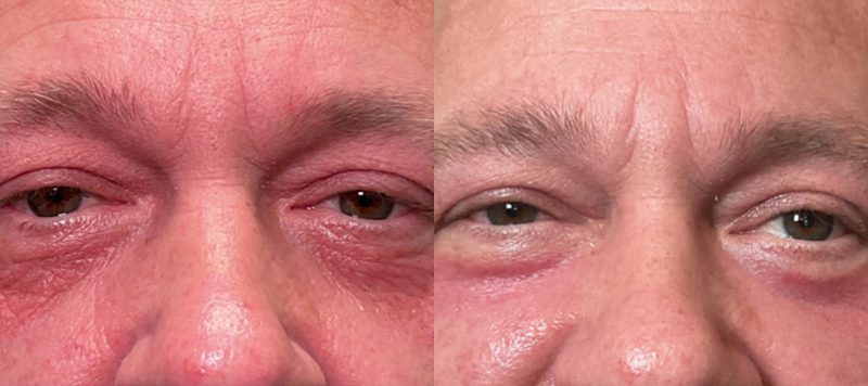 CO2 Laser Resurfacing Patient 5 Image 0