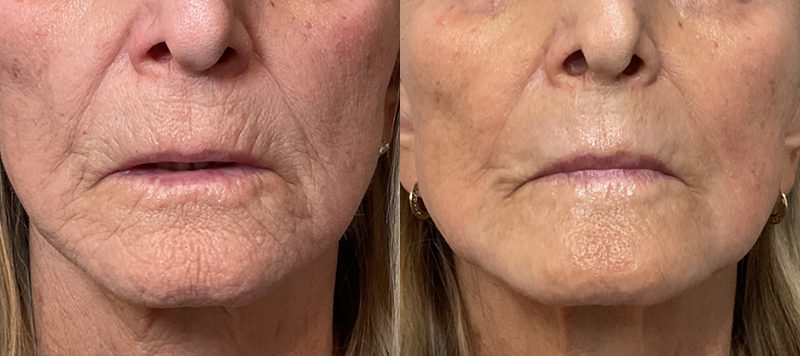 CO2 Laser Resurfacing Patient 6 Image 0