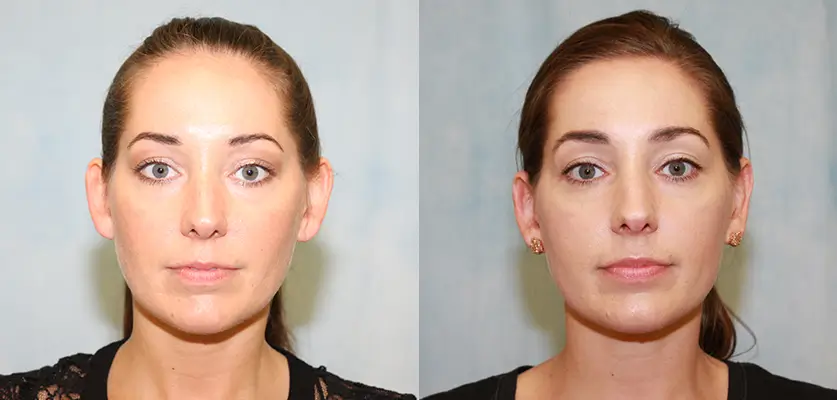 Otoplasty (Ear Pinning Surgery) Patient 1 Image 0