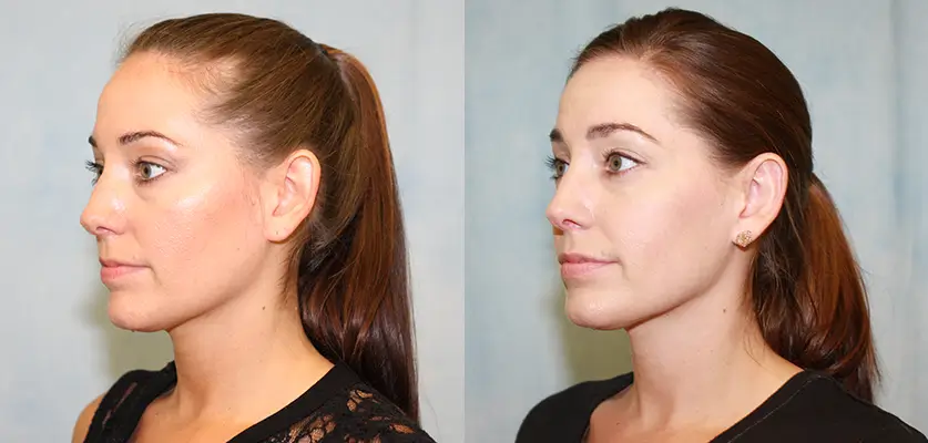 Otoplasty (Ear Pinning Surgery) Patient 1 Image 1