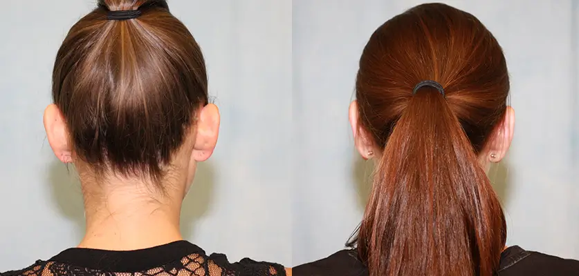 Otoplasty (Ear Pinning Surgery) Patient 1 Image 2
