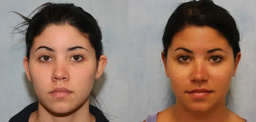 Otoplasty (Ear Pinning Surgery) Patient 2 Image 0